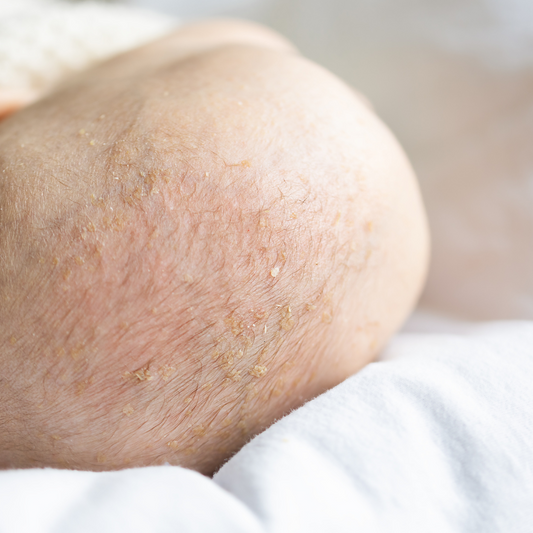 Tout savoir sur les croûtes de lait de bébé
